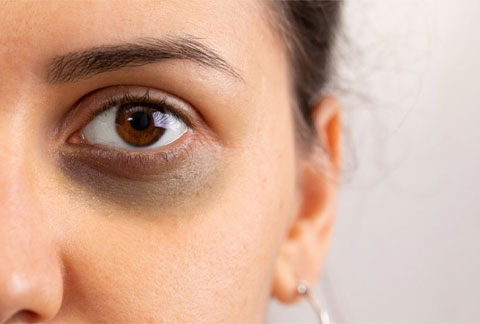 dark-circles