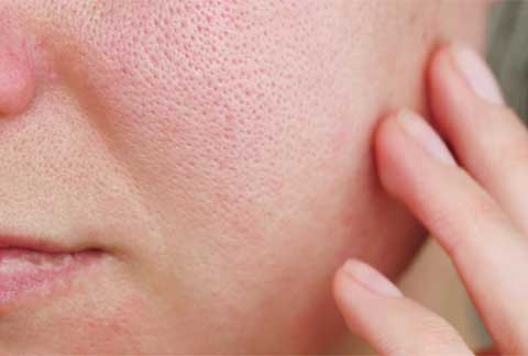 Enlarged Pores
