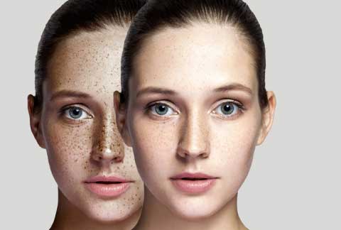 Sun Damage